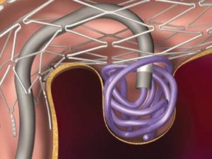 Stent Coiling